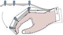 Guant ortopèdic que amplifica la força de la mà, patentat per la UPC