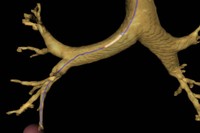 Imatge d’una broncoscòpia virtual, fruit del sistema de guiatge creat per l'IOC que permet als metges navegar virtualment per les vies respiratòries i predir el càncer de pulmó.